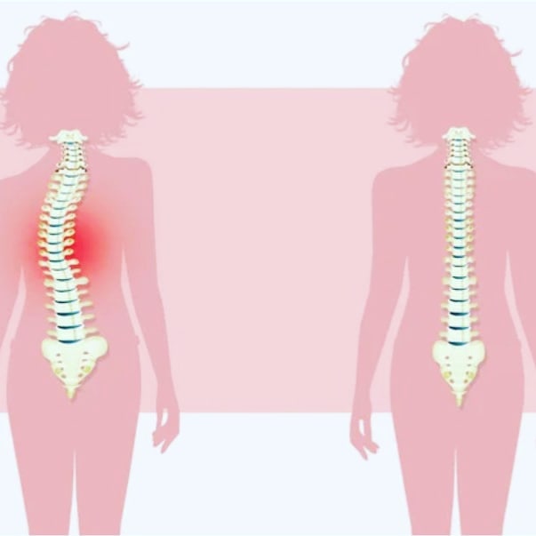 Skoliose der Wirbelsäule im Vergleich: links eine seitlich gekrümmte Wirbelsäule mit markiertem Schmerzbereich im unteren Rücken, rechts eine gerade gesunde Wirbelsäule als Referenz